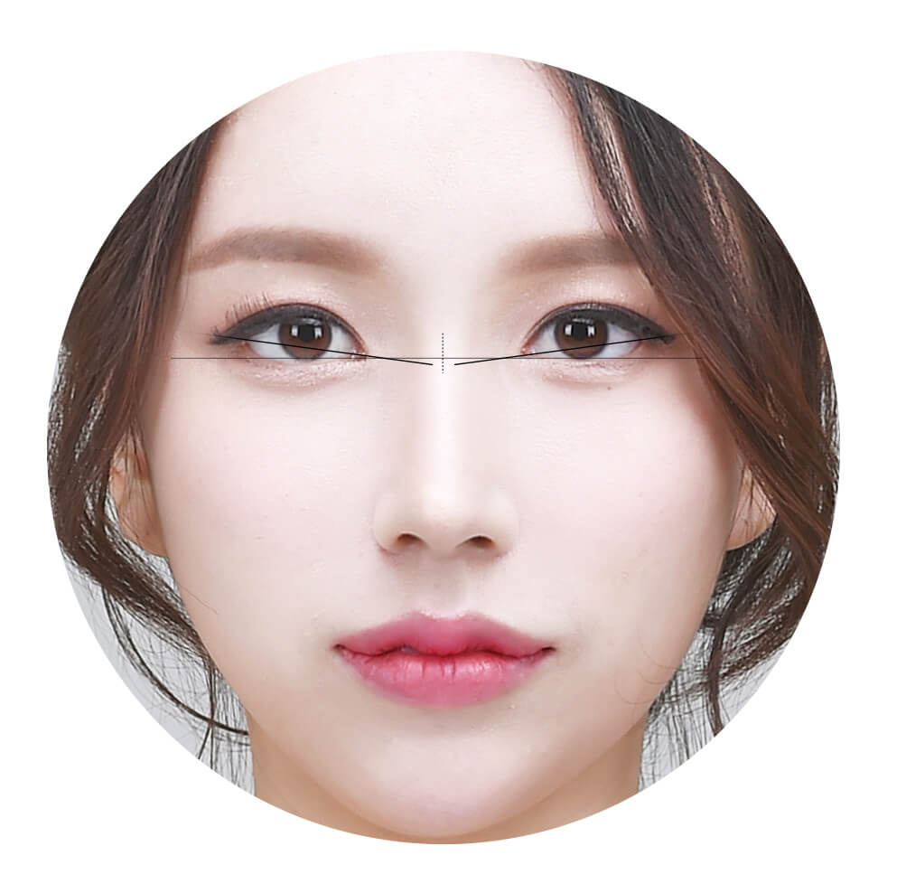 Canthoplasty for ideal eye shape | Hyundai Aesthetics Plastic Surgery