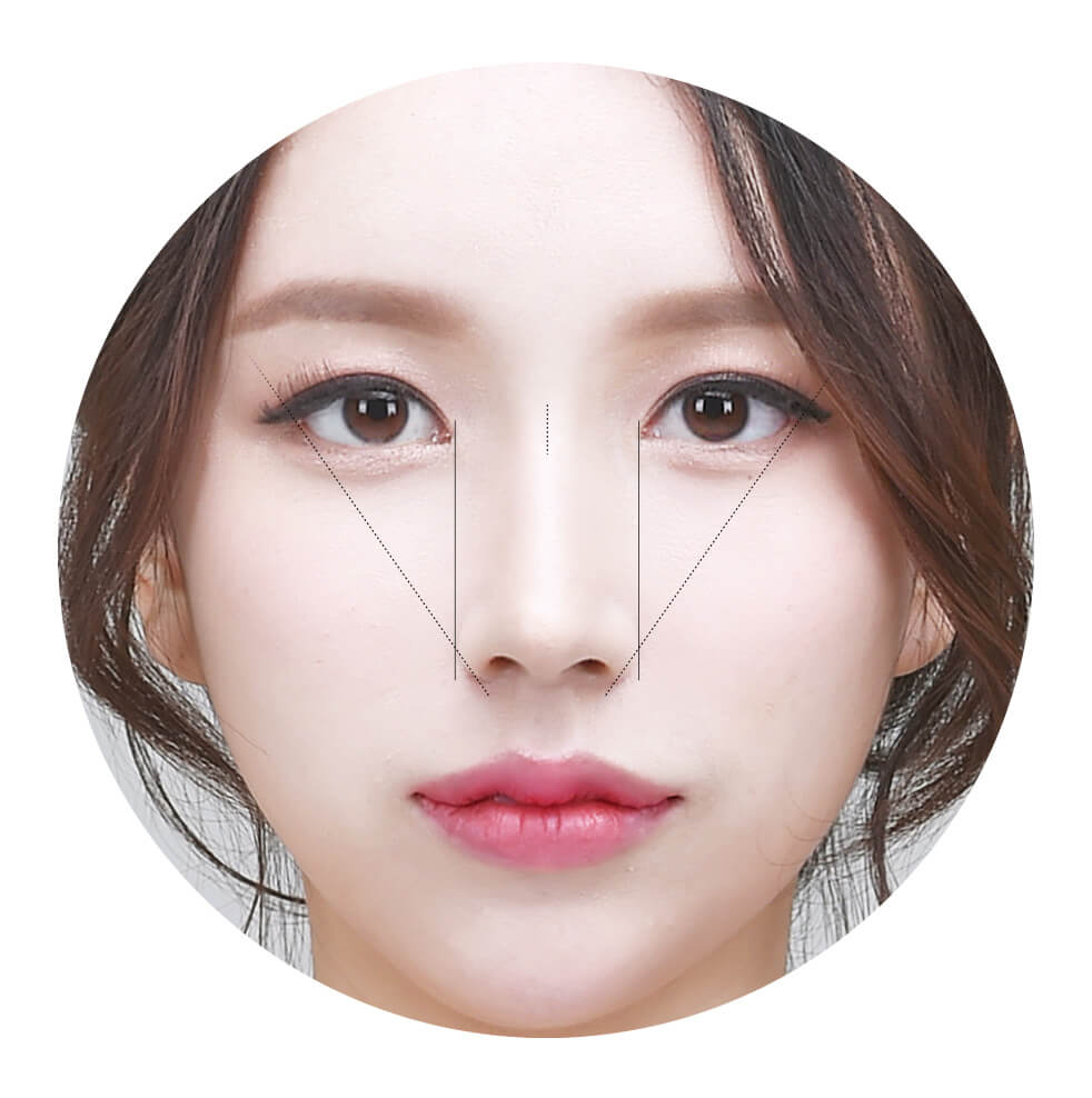 Canthoplasty for ideal eye shape | Hyundai Aesthetics Plastic Surgery