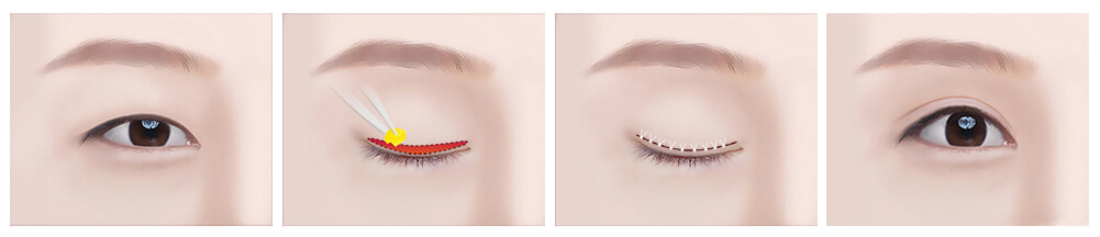 Full incision double eyelid surgery method | Hyundai Aesthetics Plastic Surgery