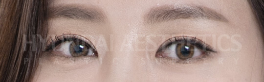In-out fold double eyelids | Hyundai Aesthetics Plastic Surgery