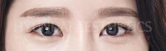 Infold double eyelids | Hyundai Aesthetics Plastic Surgery