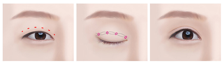 Non incision double eyelid surgery method | Hyundai Aesthetics Plastic Surgery