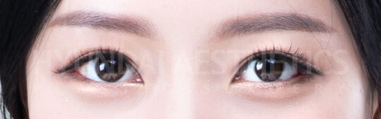 Outfold double eyelids | Hyundai Aesthetics Plastic Surgery