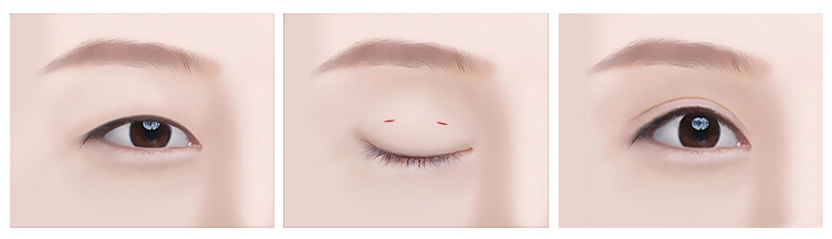 Partial incision double eyelid surgery method | Hyundai Aesthetics Plastic Surgery