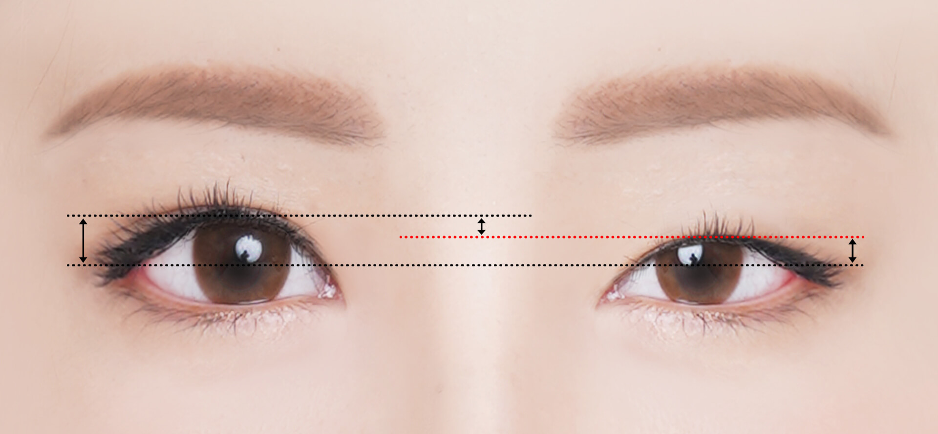 Eyes that require ptosis correction | Hyundai Aesthetics Plastic Surgery