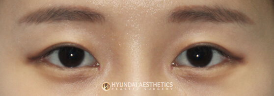 Before and after eyelid surgery | Hyundai Aesthetics Plastic Surgery