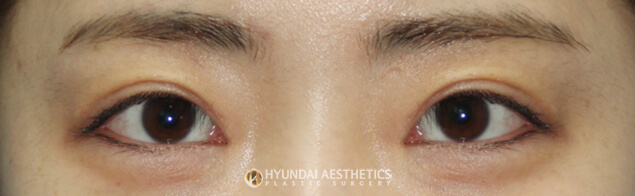 Before and after eyelid surgery | Hyundai Aesthetics Plastic Surgery