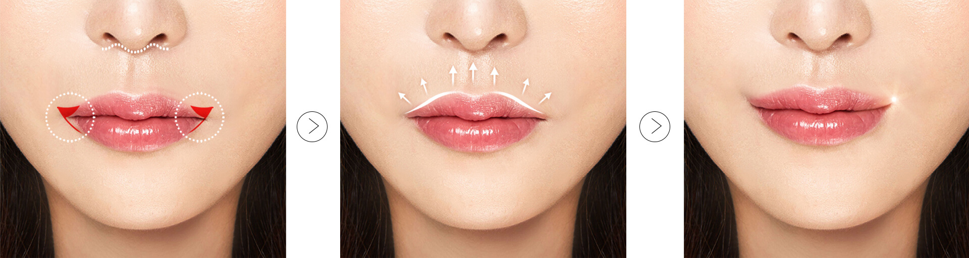 Bullhorn lip lift + Lateral philtrum reduction + smile lift surgery procedure | Hyundai Aesthetics Plastic Surgery