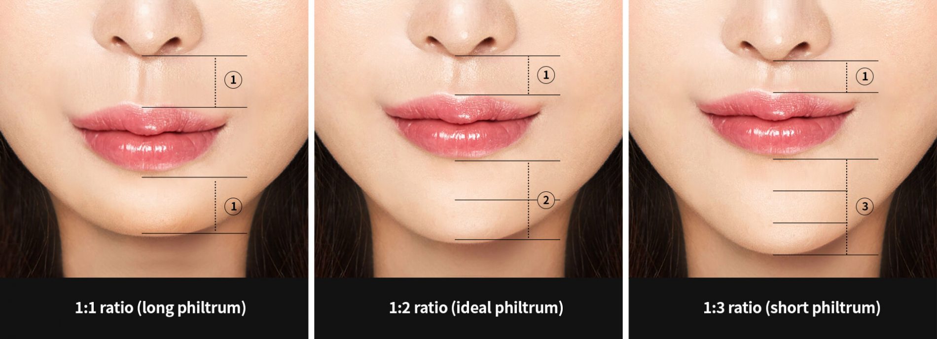 All About Philtrum Reduction Surgery Upper Lip Lift Hyundai Aesthetics Blog