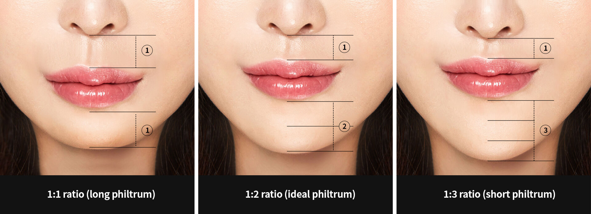 Golden ratio for ideal philtrum | Hyundai Aesthetics Plastic Surgery