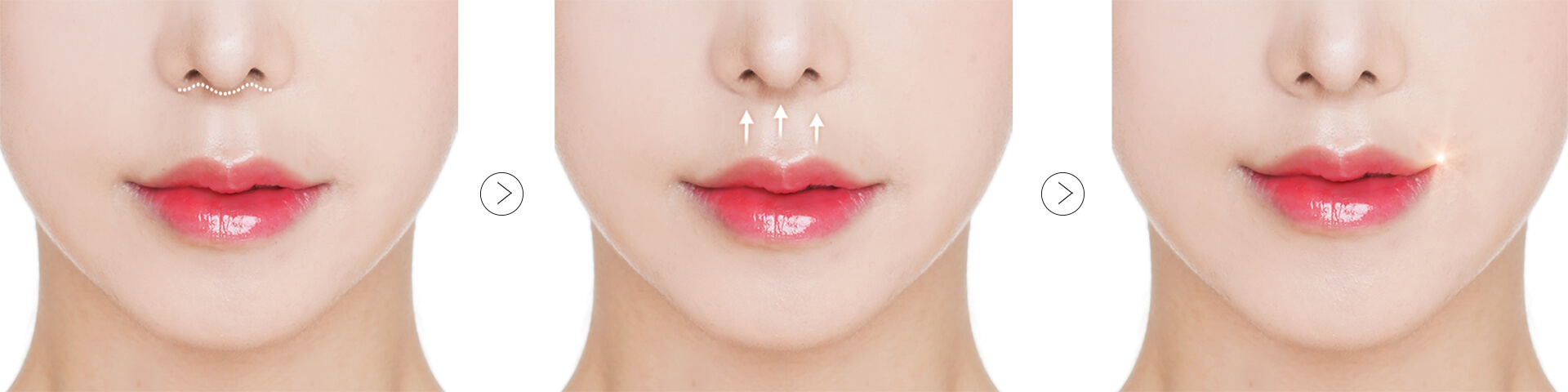 Bullhorn lip lift surgery procedure | Hyundai Aesthetics Plastic Surgery