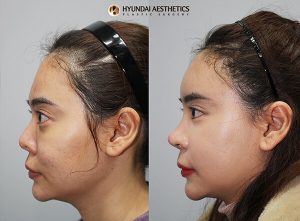 Before and After for nose surgery (rhinoplasty) - Hyundai Aesthetics Blog