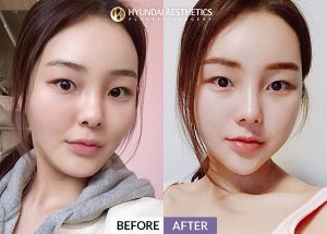 Before and After for nose surgery (rhinoplasty) - Hyundai Aesthetics Blog