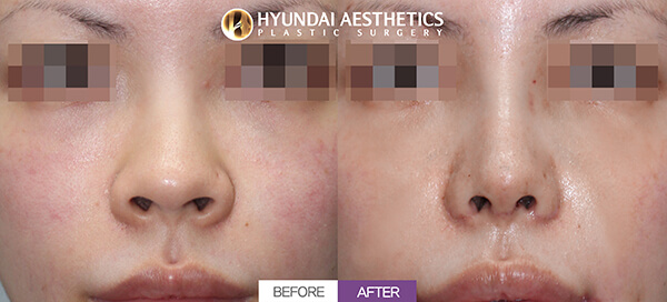 Before and after nose surgery | Hyundai Aesthetics Plastic Surgery