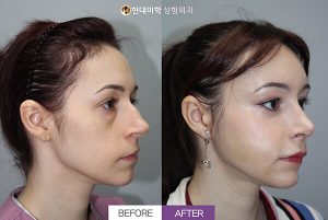 Before and After for nose surgery (rhinoplasty) - Hyundai Aesthetics Blog