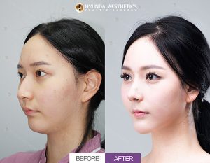 Before and After for nose surgery (rhinoplasty) - Hyundai Aesthetics Blog