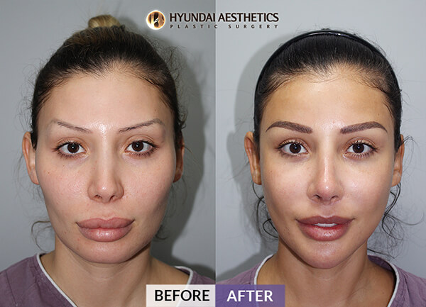 Before and After for nose surgery (rhinoplasty) - Hyundai Aesthetics Blog