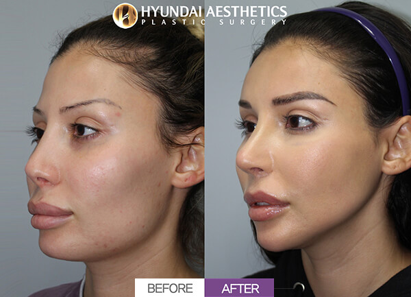 Before and after nose surgery | Hyundai Aesthetics Plastic Surgery