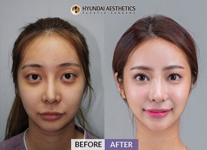 Before and After for nose surgery (rhinoplasty) - Hyundai Aesthetics Blog