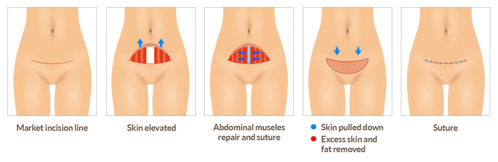 Mini tummy tuck surgery | Hyundai Aesthetics Plastic Surgery