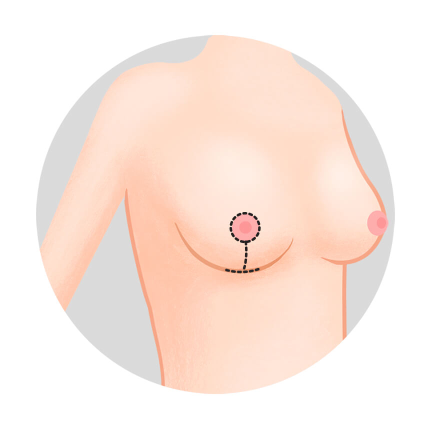 Breast lift surgery - Anchor (inverted T) incision | Hyundai Aesthetics Plastic Surgery