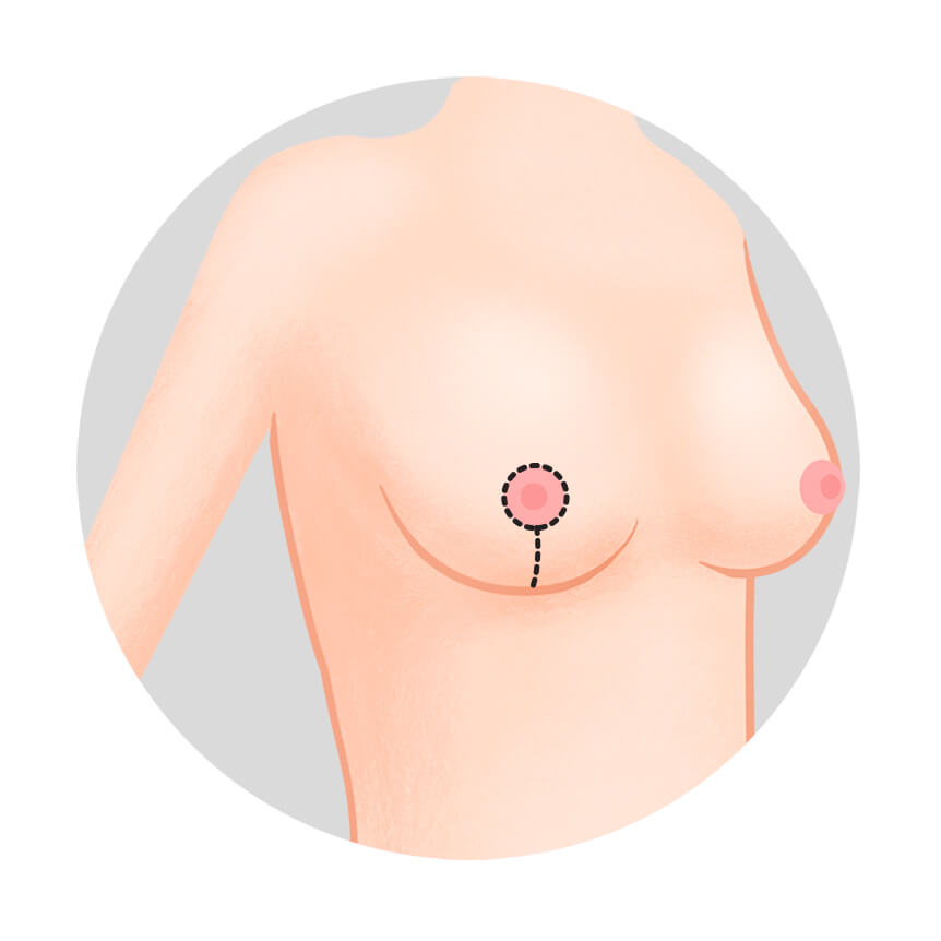 Breast lift surgery - vertical (lollipop) incision | Hyundai Aesthetics Plastic Surgery