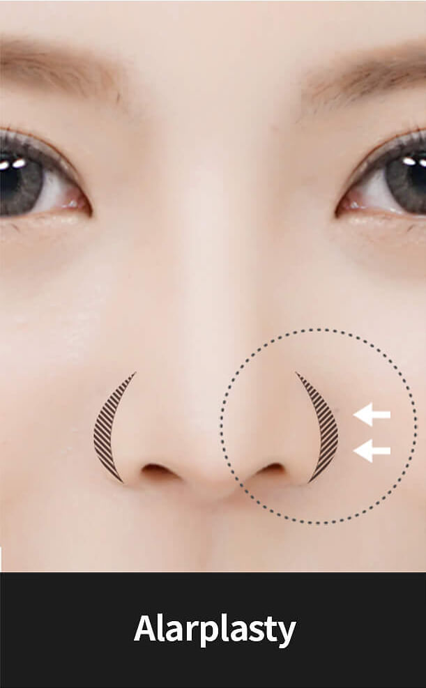 Korean nose job - Alarplasty | Hyundai Aesthetics Plastic Surgery