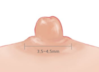 Ideal areola size for breasts | Hyundai Aesthetics Plastic Surgery