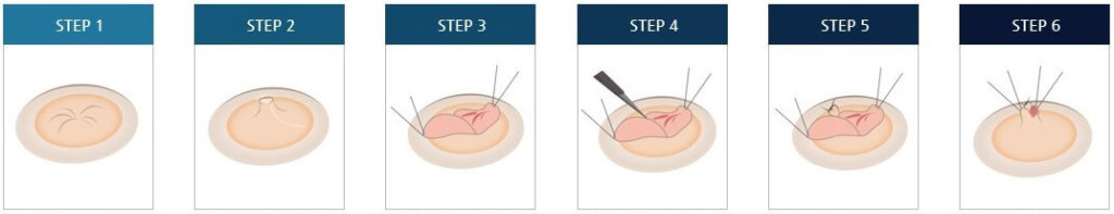 Inverted nipple surgery for severly inverted nipples | Hyundai Aesthetics Plastic Surgery