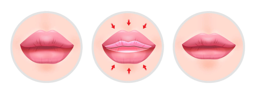 Lip reduction surgery procedure | Hyundai Aesthetics Plastic Surgery