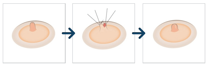 Nipple reduction procedure for large nipples | Hyundai Aesthetics Plastic Surgery