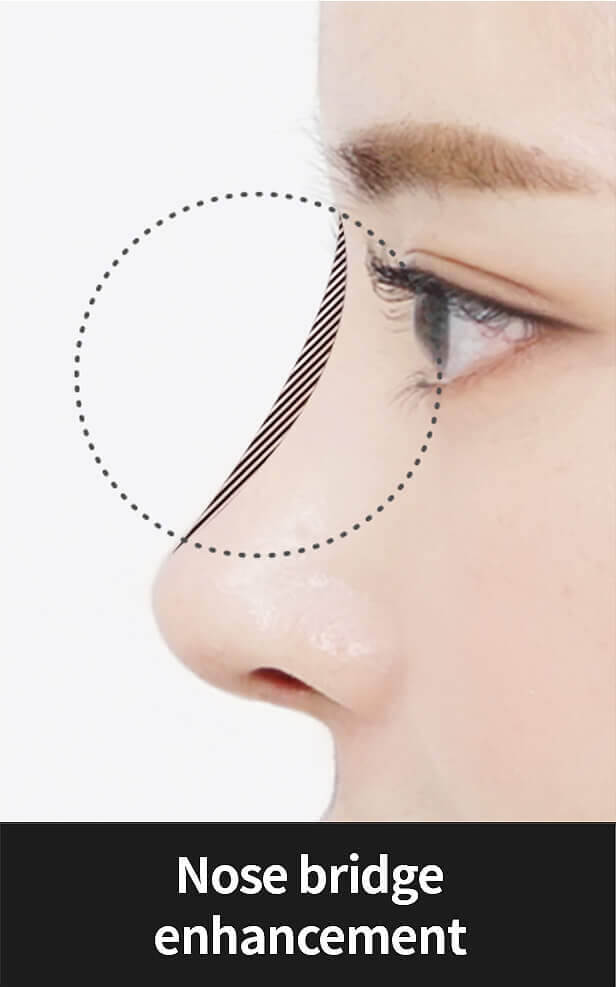 Korean nose job - Nose bridge enhancement | Hyundai Aesthetics Plastic Surgery