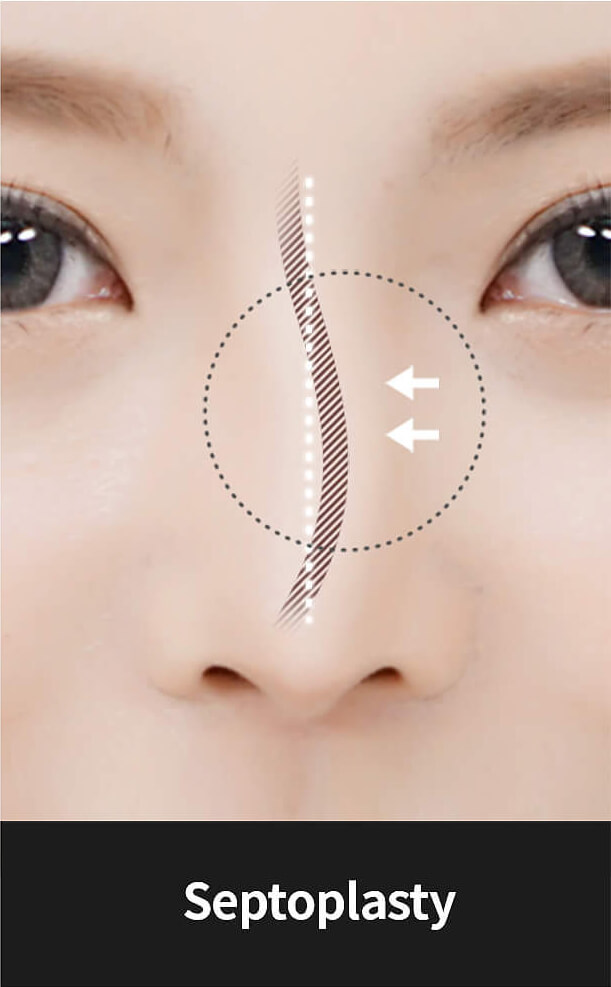 Korean nose job - Septoplasty | Hyundai Aesthetics Plastic Surgery