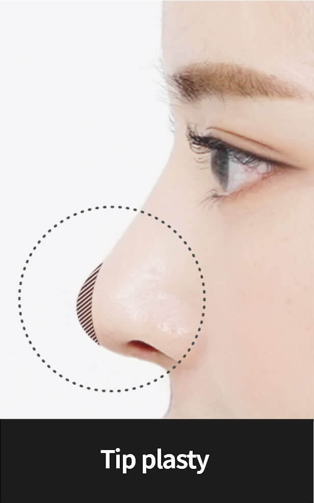 Korean nose job - Tip plasty | Hyundai Aesthetics Plastic Surgery