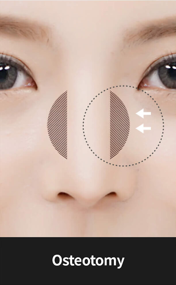 Korean nose job - Wide nose surgery | Hyundai Aesthetics Plastic Surgery