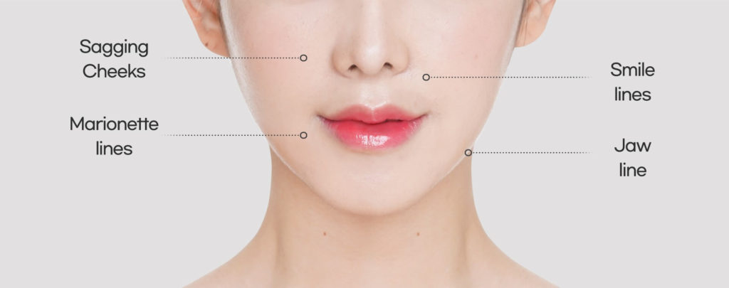 SMAS face lift target areas | Hyundai Aesthetics Plastic Surgery