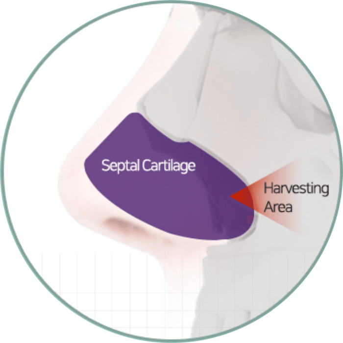 Septal cartilage | Hyundai Aesthetics Plastic Surgery